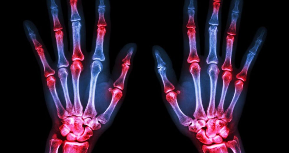 New Diagnosis Explains Why You Have Stiff Joints