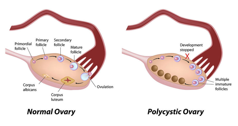 SHOCKING! Not Even Stars Are Safe: One in Five Women Suffer from Polycystic Ovary Syndrome