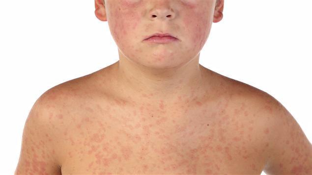 Travelers possibly exposed to measles according to Ottawa Public Health