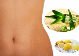 Best Natural Remedies Against Stretch Marks