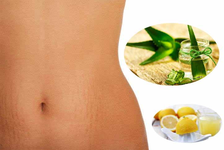Best Natural Remedies Against Stretch Marks