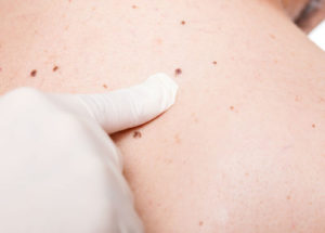 How Do You Know If Your Moles Are Dangerous Or Not