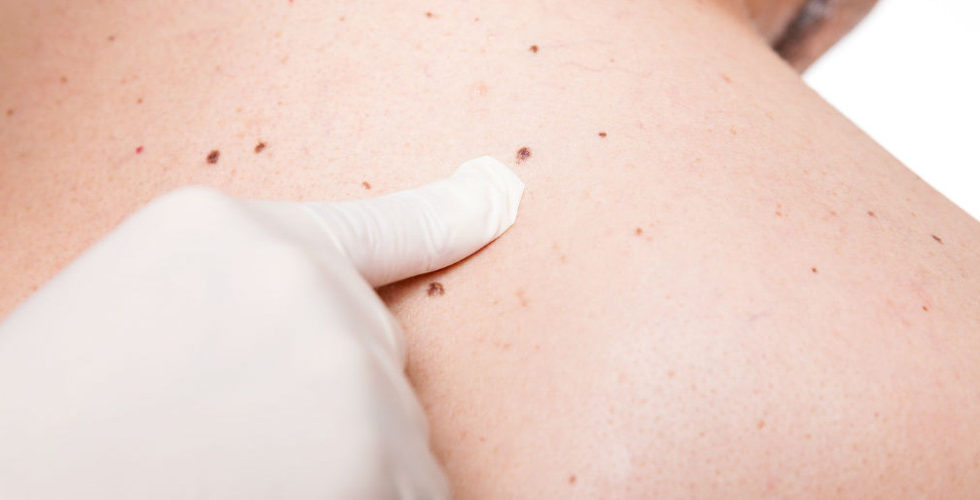How Do You Know If Your Moles Are Dangerous Or Not