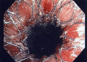 Esophageal Treatment – Better Responses for Female Patients