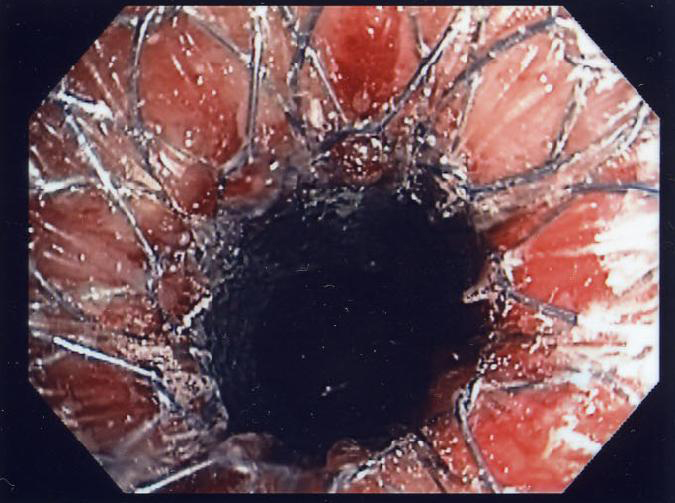 Esophageal Treatment – Better Responses for Female Patients