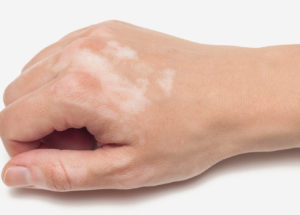 4 Natural Remedies For Vitiligo That Will Improve Your Condition