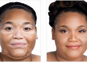 Vitiligo – Manifestations And Symptoms Of The Disease