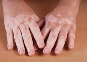 Vitiligo – Signs Of The Disease, Causes And Recommendations