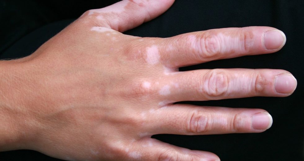 Is There A Correlation Between Vitiligo Repigmentation And Cancer?