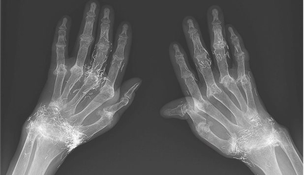 Bizarre Medical Case: A Woman has her Wrists full of Gold