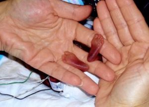 The ‘Miracle Baby’ Girl Born at 21 Weeks is Now 3 Years Old – The Most Premature Infant to Survive