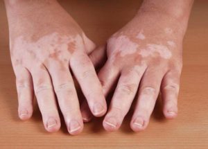 Vitiligo Cure Discovered After Years Of Research