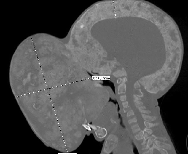 Boy with 10 Pound Tumor will be Operated in Miami