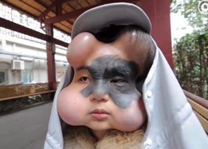 Doctors Try To Remove A Dangerous Birthmark By Implanting Four Balloons Under A Woman’s Face