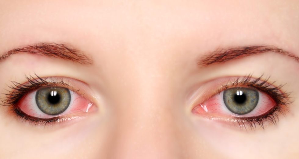 Best Natural Remedies For Red Eyes And Conjunctivitis
