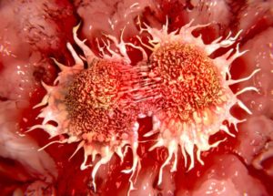Surviving Cancer Linked To Where You Live, A New Study Revealed