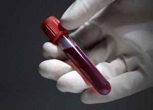 The Blood Tests To Diagnose Brain Injury Are Now Approved By The FDA