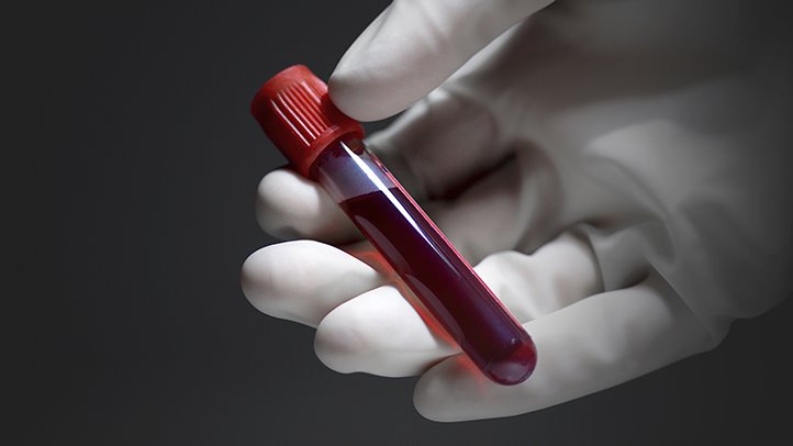 The Blood Tests To Diagnose Brain Injury Are Now Approved By The FDA