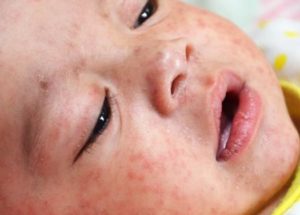 Second Measles Case Was Confirmed In Brampton
