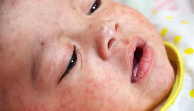 Second Measles Case Was Confirmed In Brampton