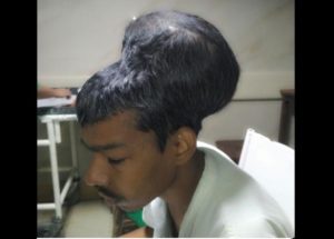 Doctors Have Surgically Removed The Largest Brain Tumor In The World