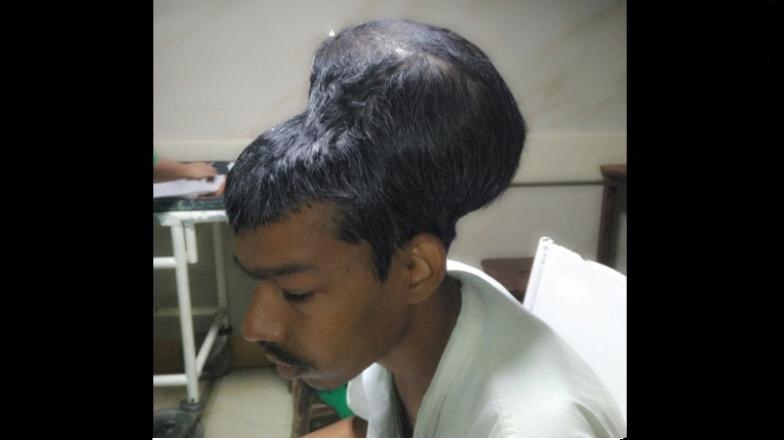 Doctors Have Surgically Removed The Largest Brain Tumor In The World