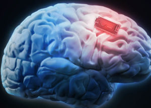 Addiction Can Be Treated With Brain Implants