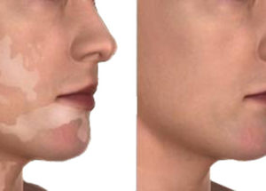 A Possible Treatment For Vitiligo Has Been Recently Discovered At The Yale University