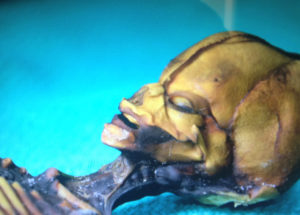The Atacama Skeleton Is Not An Extraterrestrial Being But A Baby With Rare Mutations, A New Study Reveals