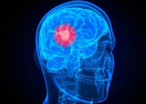 Constipation Virus Destroys Glioblastoma Brain Tumors Cells, A Study Revealed