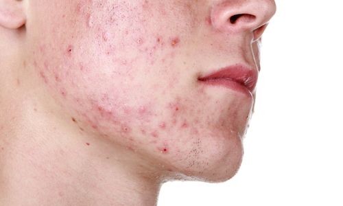 Researchers Found Out That Sugar Is Causing Acne In Teenagers
