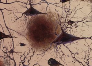 Alzheimer’s Plaques Can Be Eliminated From The Brain With Specific Antibodies, A New Study Shows