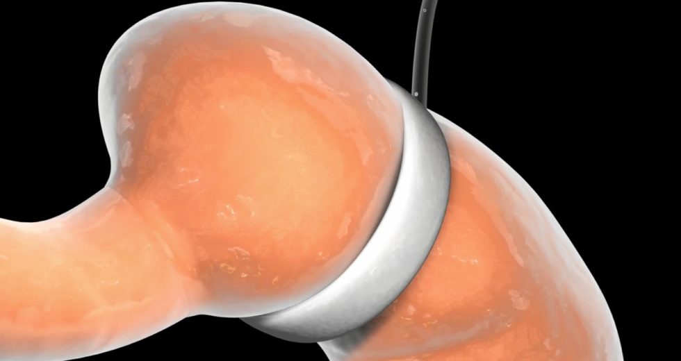 Diabetic And Obese Teenagers Can Improve Their Conditions With Bariatric Surgery