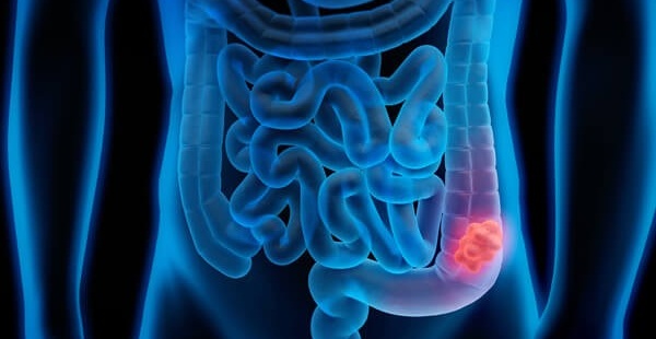 Australian Have To Wait Up To 6 Months To Get Diagnosed With Bowel Cancer