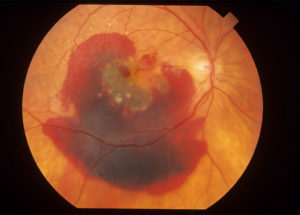 Macular Degeneration Caused By Aging, Or Maculopathy, Can Be Treated With Stem Cells
