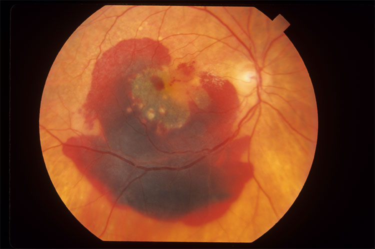 Macular Degeneration Caused By Aging, Or Maculopathy, Can Be Treated With Stem Cells