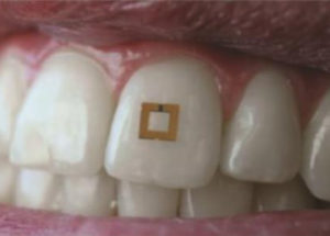 A Wireless Sensor Can Be Attached To One Tooth And Can Track What You Eat