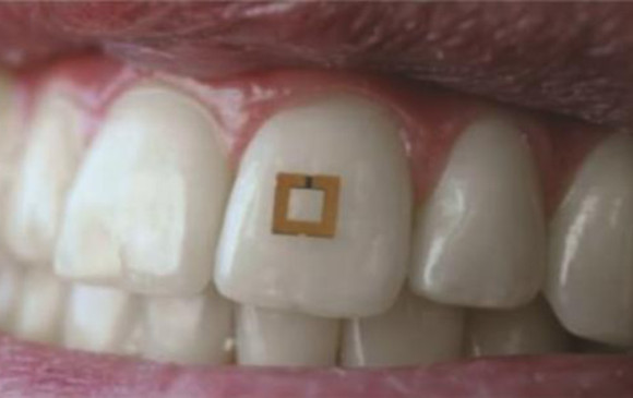 A Wireless Sensor Can Be Attached To One Tooth And Can Track What You Eat