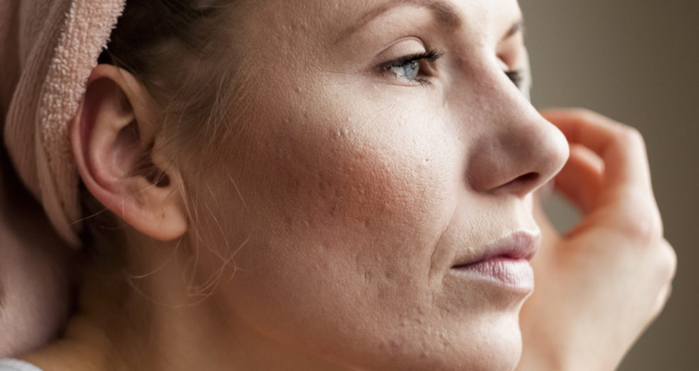 How to Deal with Acne as an Adult