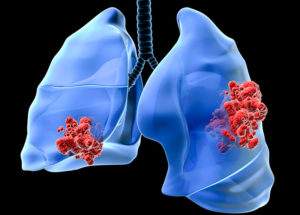 Immunotherapy, a Wonder for the Lung Cancer Patients