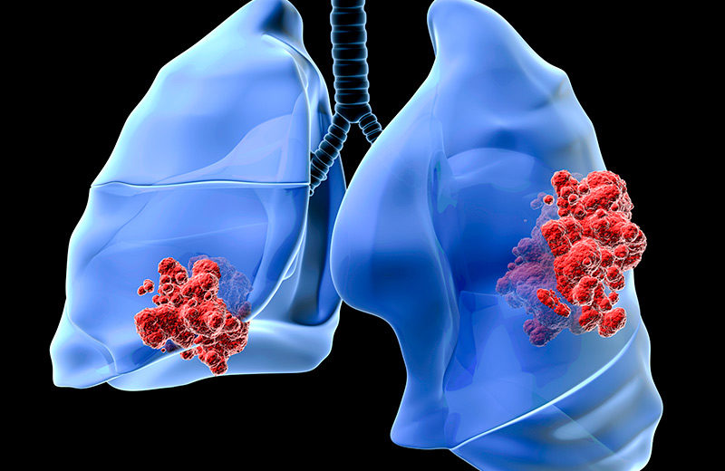 Immunotherapy, a Wonder for the Lung Cancer Patients