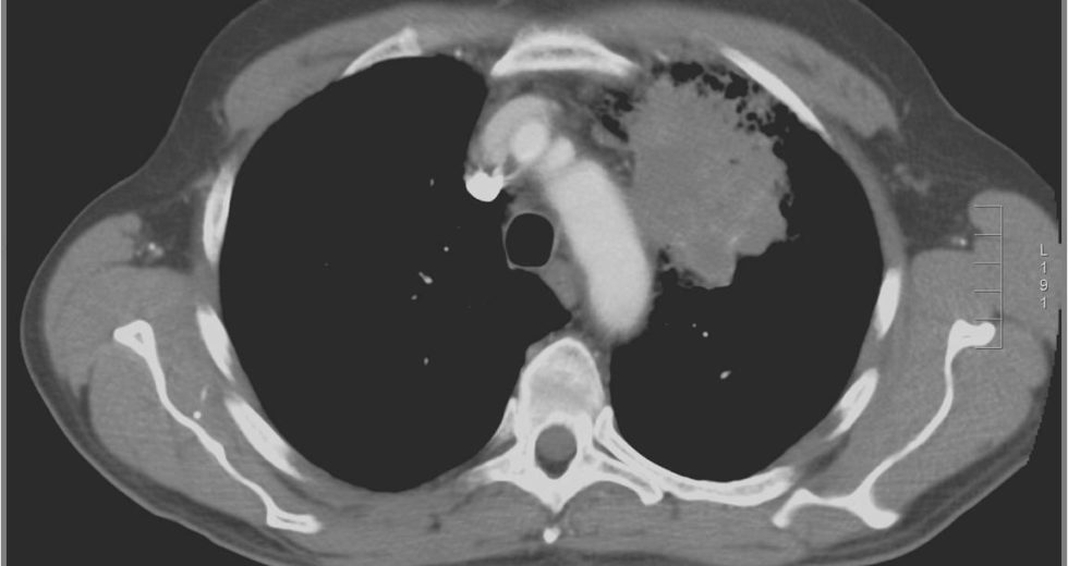 Lung Cancer Scan will be a Must for Queenslanders Deemed at Risk