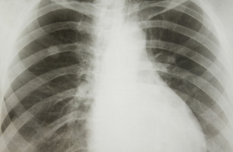 Pembrolizumab plus Chemotherapy Study in Metastatic Lung Cancer