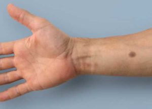 A Biomedical Tattoo Able Of Detecting 4 Forms Of Cancer Has Been Developed By Swiss Researchers