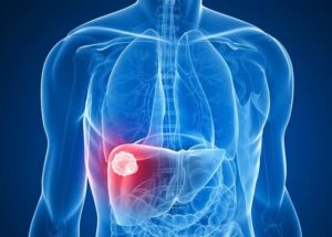 Liver Cancer Caused By Non-Alcoholic Fatty Liver Disease Might Be Treated With A Common Fungicidal Drug