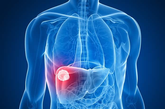 Liver Cancer Caused By Non-Alcoholic Fatty Liver Disease Might Be Treated With A Common Fungicidal Drug