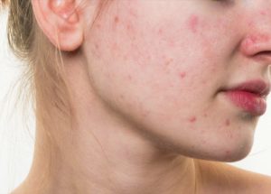 Treatments For Acne Don’t Have To Be Complex – Here Are Some Simple-To-Follow Tips And Treatments