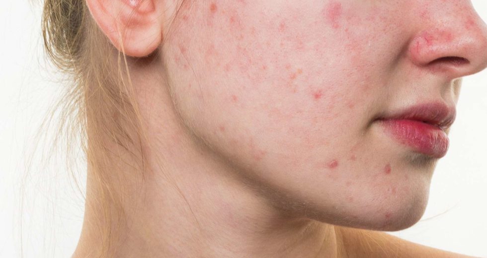 Treatments For Acne Don’t Have To Be Complex – Here Are Some Simple-To-Follow Tips And Treatments