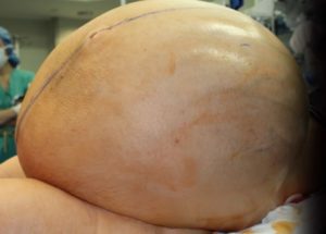 Ovarian Tumor Weighing 133 Pounds Was Successfully Removed From A Woman At The Danbury Hospital In Connecticut