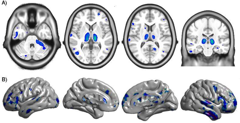 Brain Atrophy to be Avoided by Early HIV Treatment